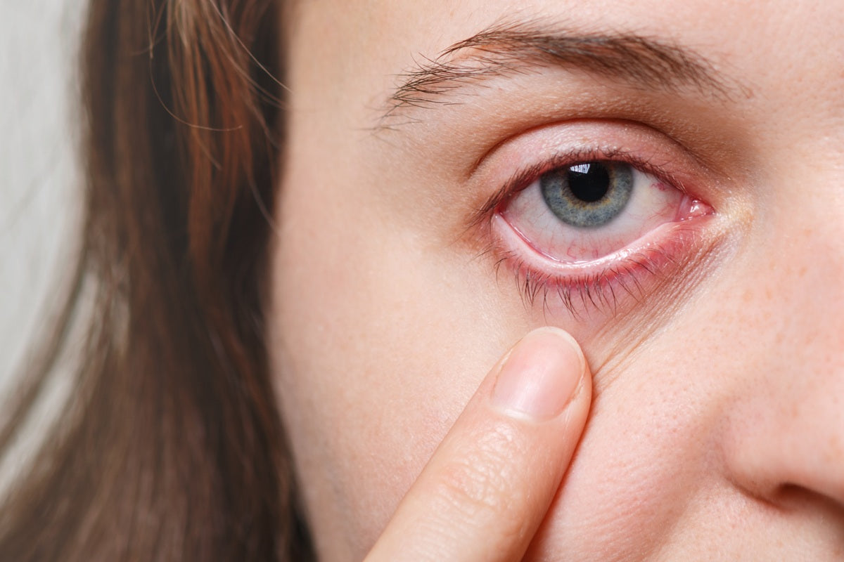 Do edibles make your eyes red?